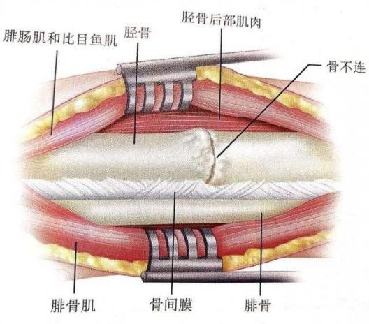 康复锻炼后骨折处疼痛肿胀,手腕骨折康复锻炼后疼痛