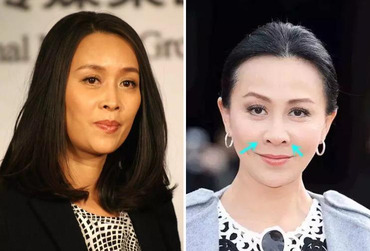 鼻子塌山根低鼻孔外露没福气吗,鼻子塌而且不露鼻孔