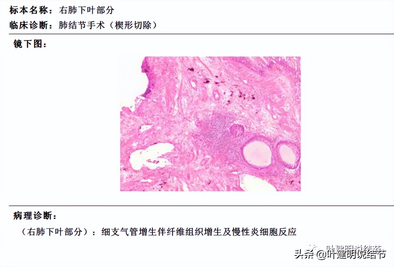 肺蜂窝状改变是肺癌吗,肺部陈旧灶与肿瘤怎么确诊
