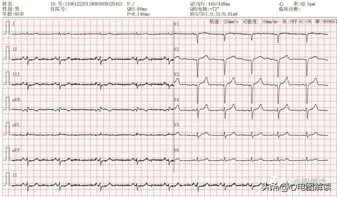 肢体导联低电压倾向严不严重,啥叫肢体导联低电压