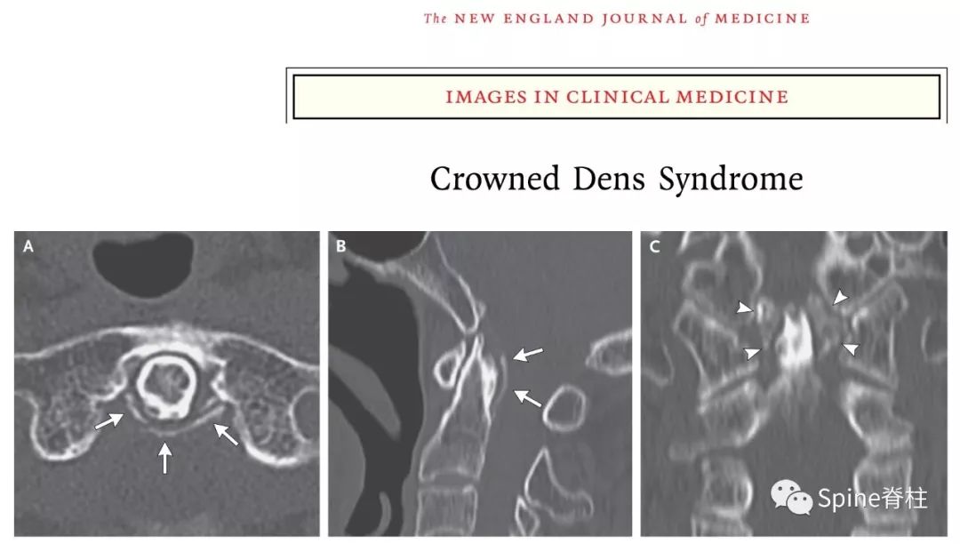 颈椎常见病变图片,颈椎严重的病例