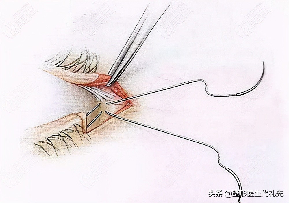 整形医生俞海燕眼睑外翻,眼睑外翻怎么修复