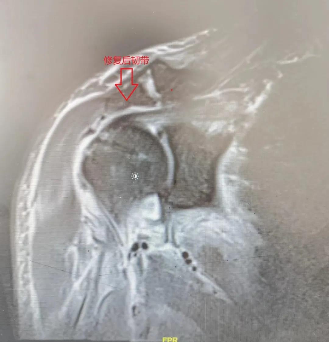 郑大一附院肩袖损伤专家,山大二院哪个专家看肩袖损伤好