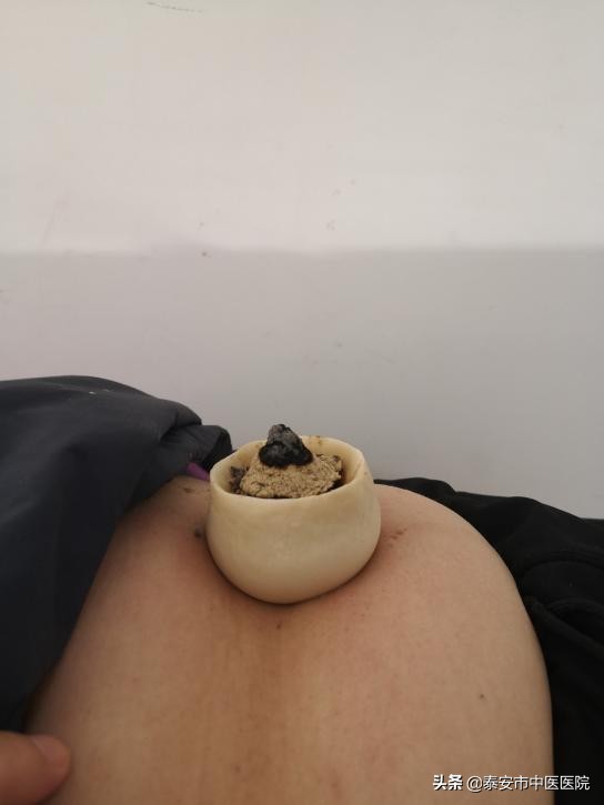 【特色疗法】针灸、脐疗联合治疗压力性尿*禁失**