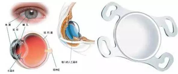 体内有金属植入患者怎么做核磁,体内有植入物可以做磁共振检查吗