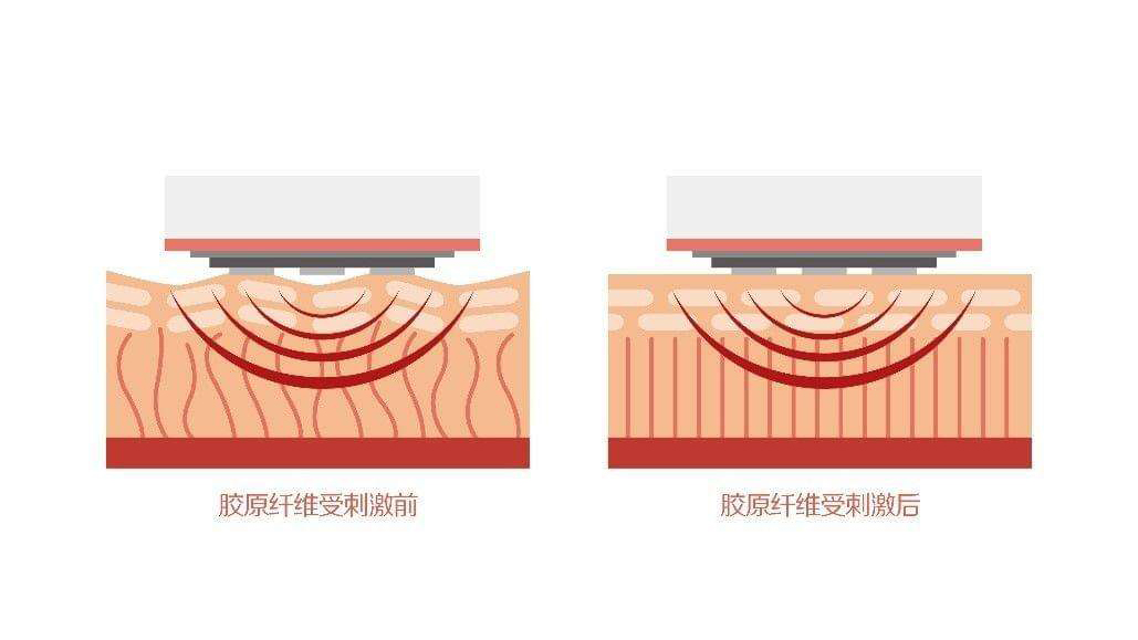 美容仪凝胶可以用平替吗,美容仪专用凝胶是什么成分