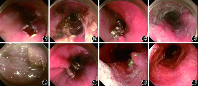 双通道内镜手术技术,单侧双通道内镜微创技术