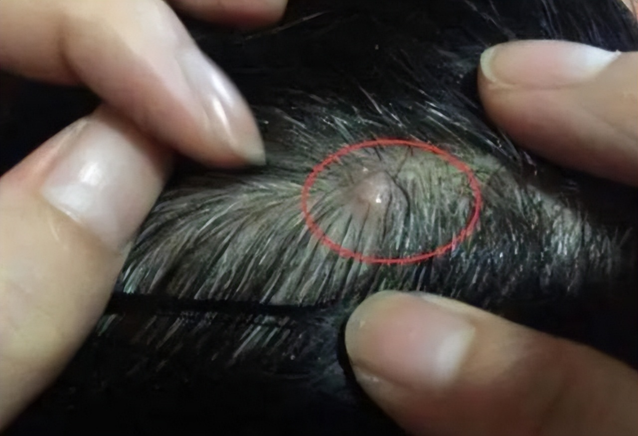 为什么头皮上老是长脓包和疙瘩？医生说出原因和改善方法