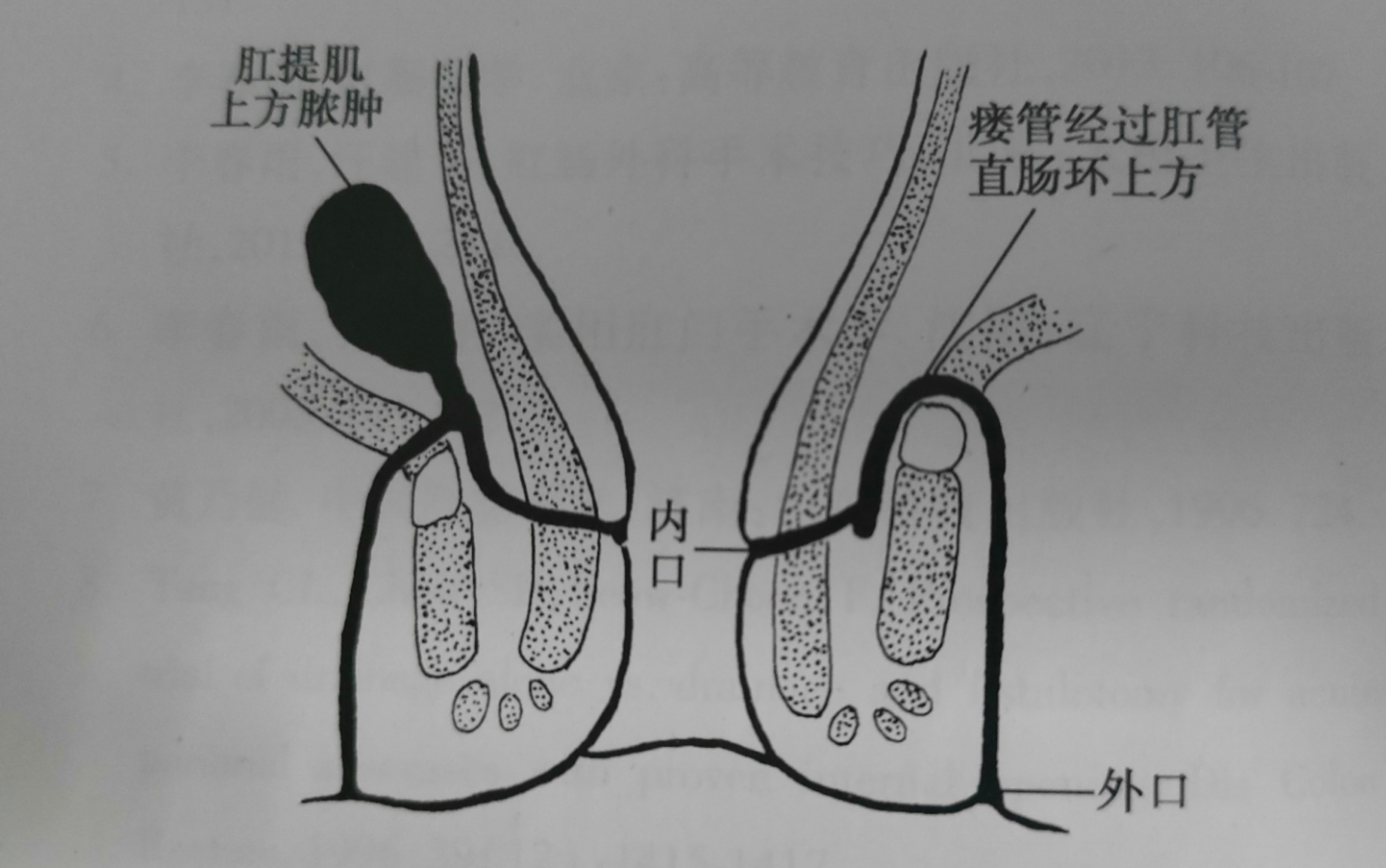 为什么有些人肛瘘一个星期就好了,为什么有的肛瘘术后不需要换药
