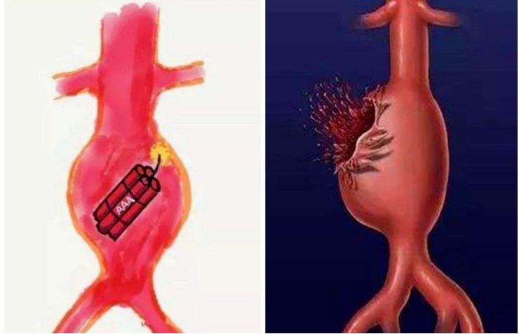 主动脉弓动脉瘤保守治疗,动脉瘤最先进技术