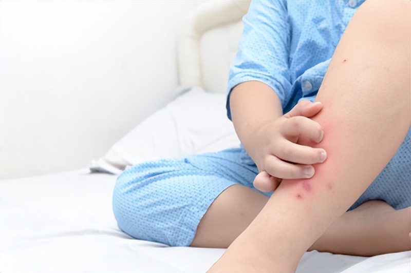 被蚊子咬快速止痒小妙招,蚊子咬的痒吃什么药止痒