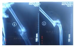 肱骨骨折取钢板怎样恢复,肱骨近端骨折切开复位内固定术
