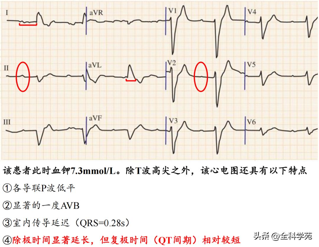 t波高尖心电图判断标准,t波高尖判断标准