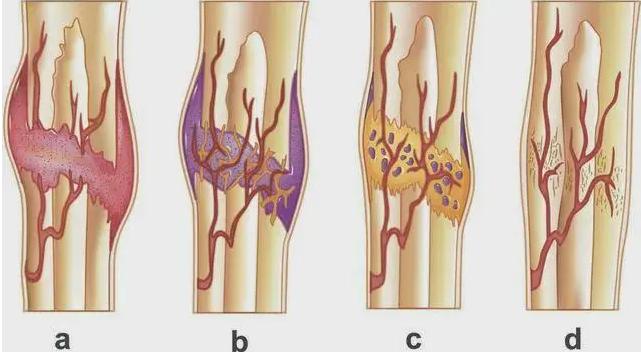 骨折以后要注意什么饮食呢,骨折后饮食应注意哪些呢