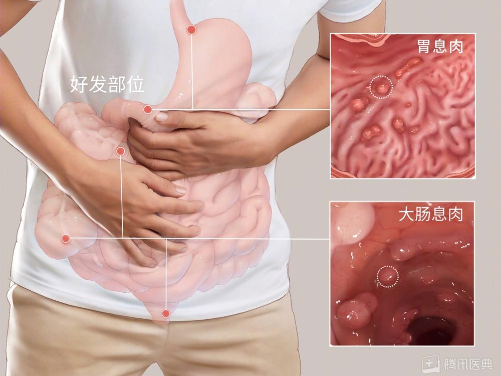 大便前头干硬后边软粘是怎么回事,上厕所时大便前头干硬后边软粘