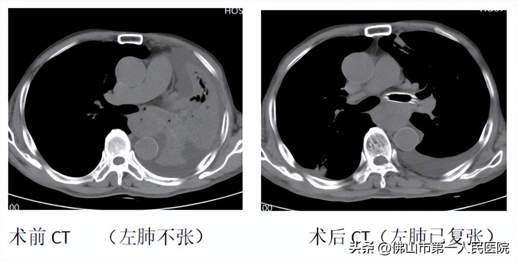 食道癌抢救病人视频,食道癌呼吸困难需要放支架吗