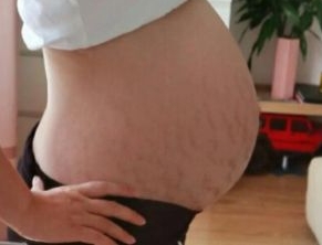 产后如何淡化妊娠纹一个妙招,产后淡化妊娠纹最有效的方法