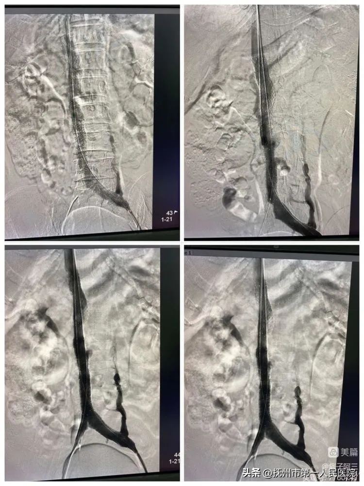 布加氏综合征介入治疗的注意事项,布加综合征介入手术加支架的利弊