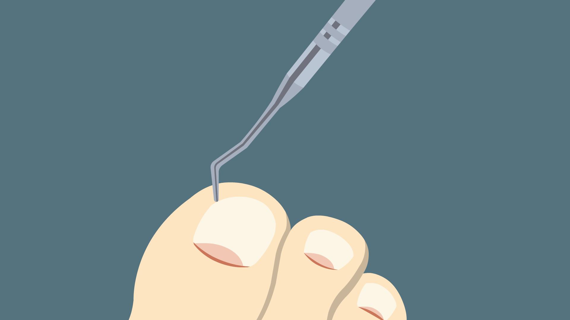 得了甲沟炎一定要拔指甲就能好吗,甲沟炎指甲陷肉里拔不出来怎么办