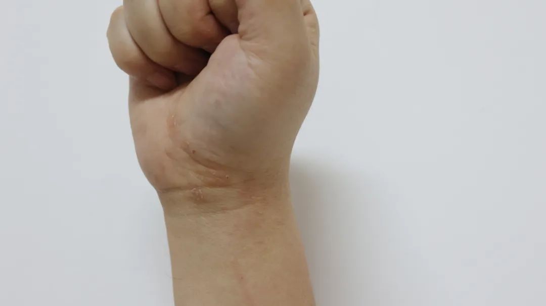 湿疹在中医里面是什么原因引起的,2岁小孩湿疹的中医最佳治疗方法