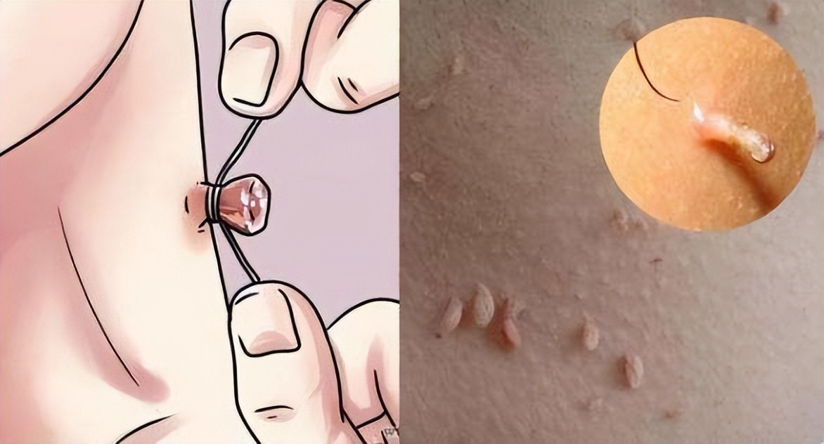 皮肤长“小肉球”是怎么回事，可以抠掉吗？该如何去除？望知晓