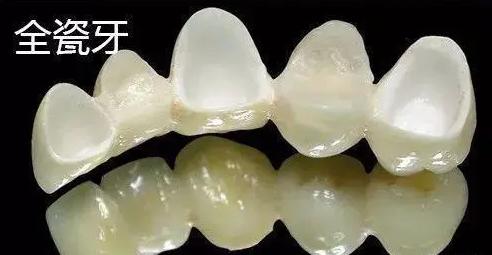 全瓷牙和烤瓷牙哪个质量好一点,全瓷牙和烤瓷牙的图片对比