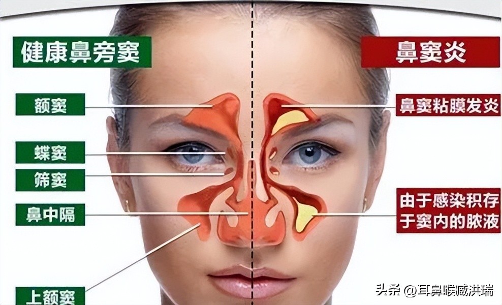 鼻中隔偏曲加上颌窦炎,鼻中隔偏曲和鼻甲手术区别