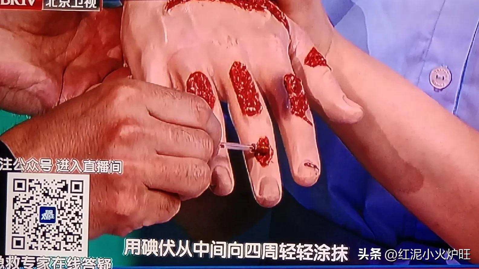 外伤消毒碘伏or酒精？大部分人都做错！