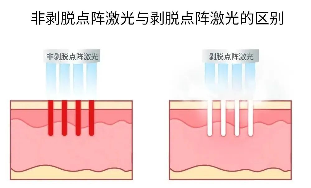 点阵激光是用来干嘛的,点阵激光的副作用和危害