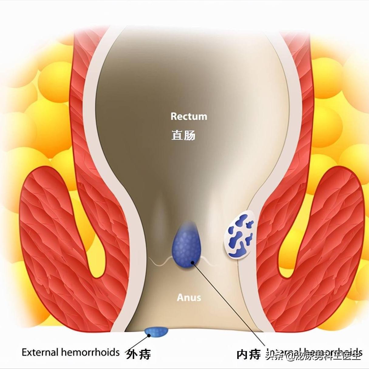 肛门发痒有分泌物,肛门潮湿发痒有分泌物怎么治