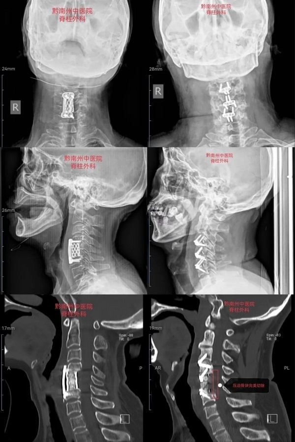 脊柱外科的最新突破,贵州中医二附院脊柱骨科