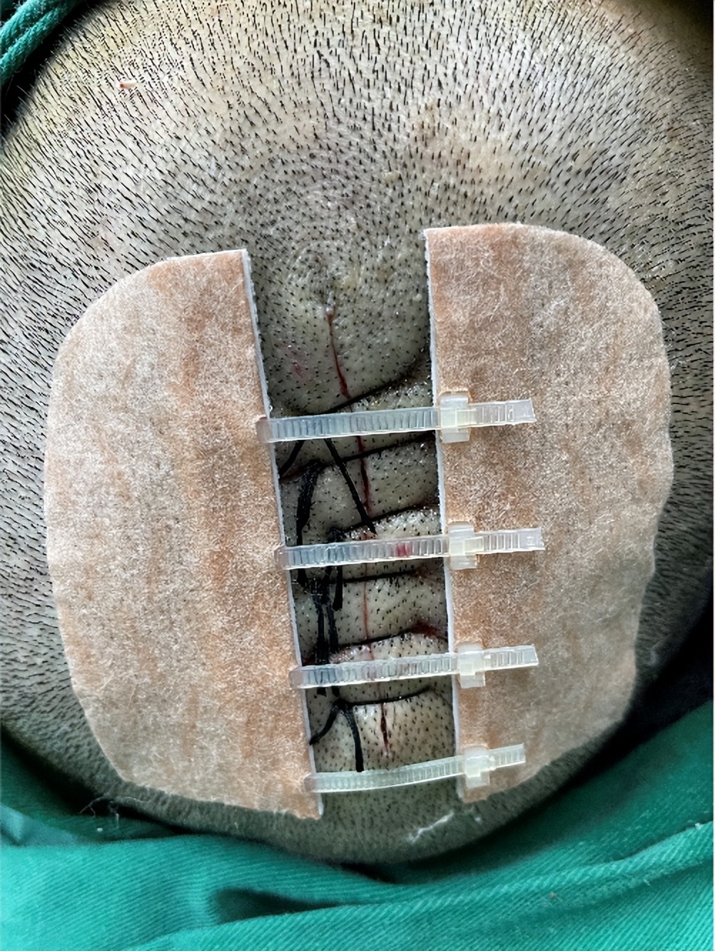 头上长了红色斑要注意了,头上有斑块怎么治