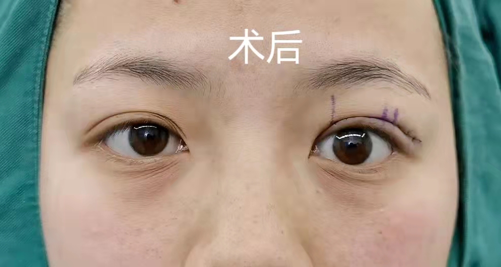 河南女孩眼睛,小女孩眼睛不一样大