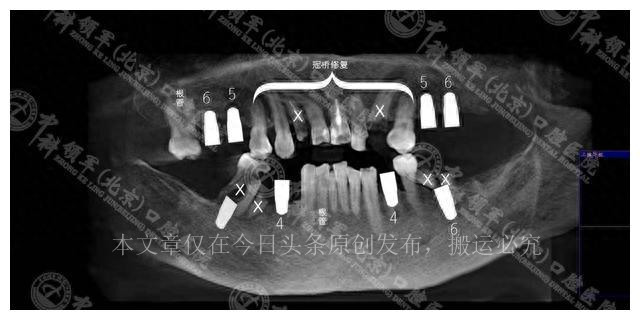 女儿做种植牙手术,老年人做全口种植牙