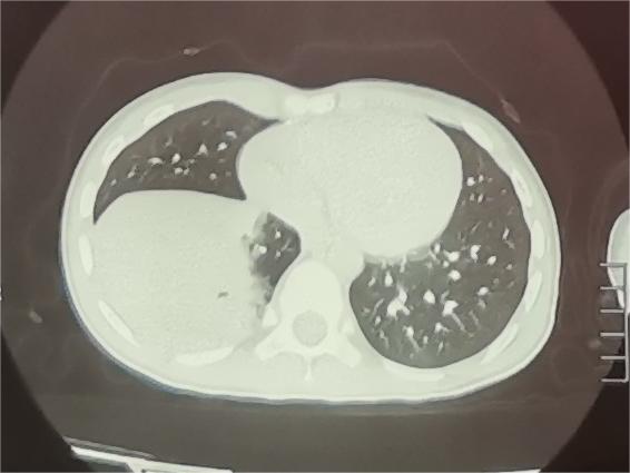 肺炎支原体阳性反反复复,支原体肺炎为什么反反复复治不好