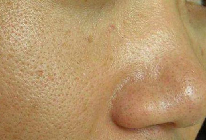 毛孔粗大的原因和小方法,毛孔粗大是如何形成的