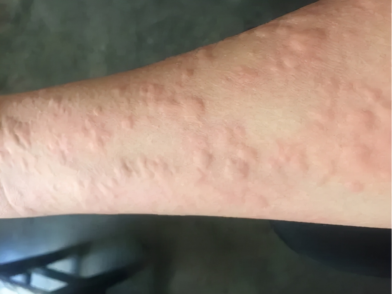 皮肤荨麻疹症状出现的原因,风团荨麻疹是怎么引起的