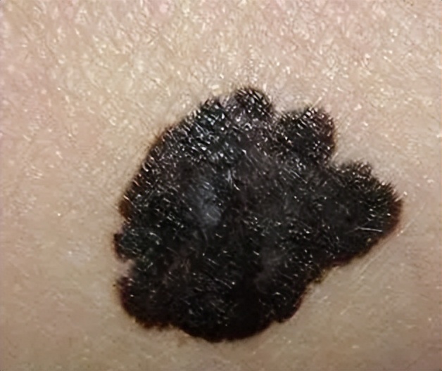 男子长了1000个鸡眼,58岁男性脚底长了一个包一碰就疼