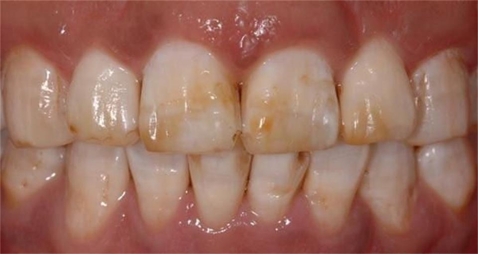 学生党牙黄怎么刷才能刷干净,白牙小妙招1天见效