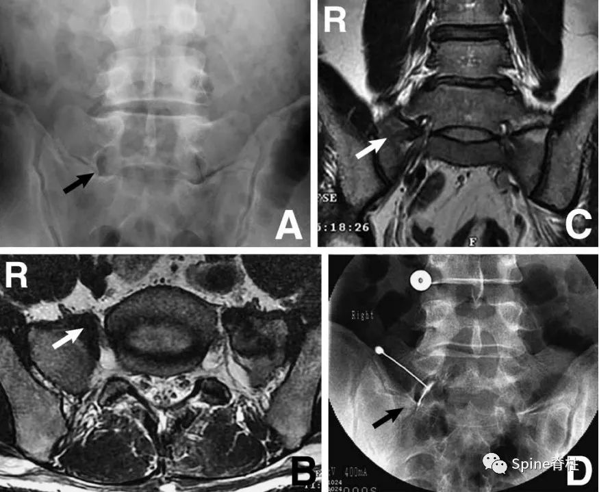 腰椎间盘突出下肢放射痛严重吗,下肢放射疼痛是间断性严重吗