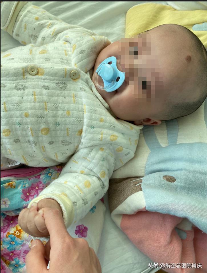 神外微创手术,脑出血颅骨修补术对癫痫有改善吗