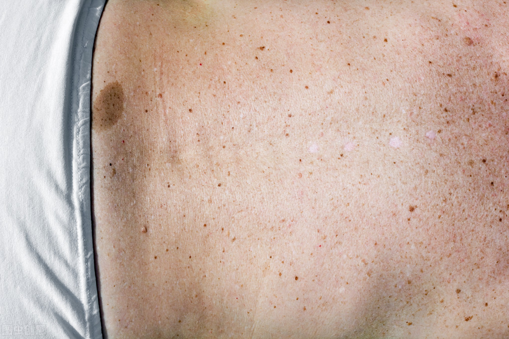 人老了为啥长老年斑,人老了脸上老年斑越来越多