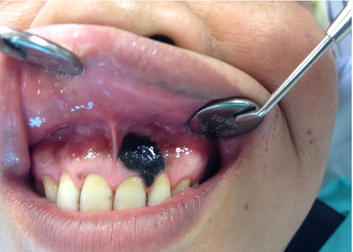 嘴唇有浅黑色斑块是怎么回事,嘴唇有黑色斑块是怎么回事