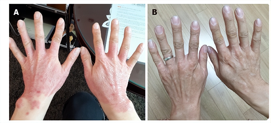 再生医学日本,日本再生医学治疗肾最新进展