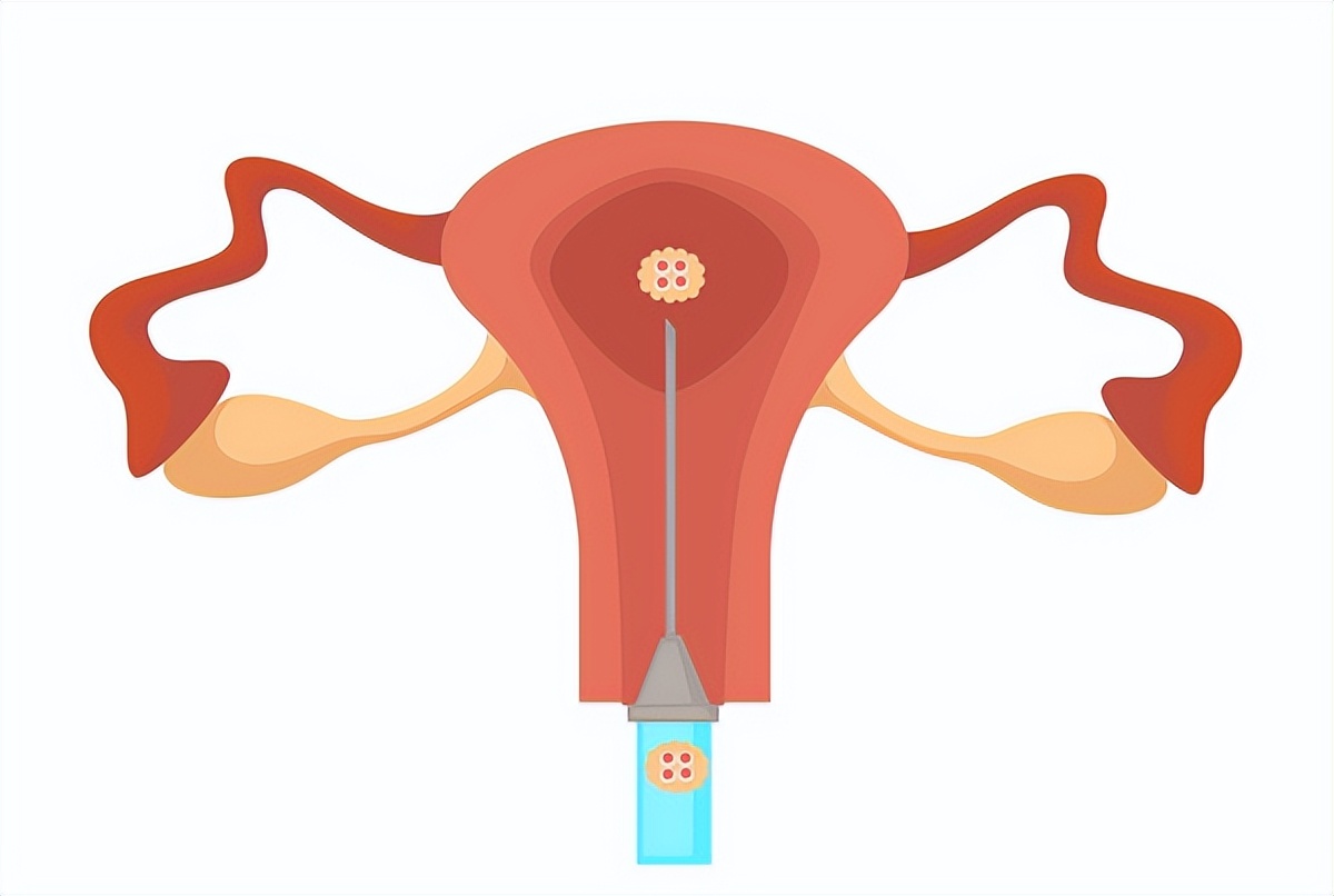 人工授精是怎么个授精法？