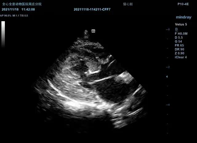 二尖瓣发育不良病例总结