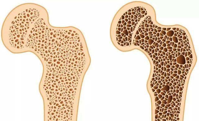 普罗力治疗骨质疏松,雌激素治疗骨质疏松