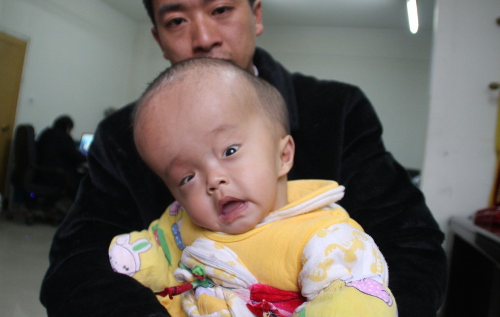 婴儿轻度脑积水是什么原因引起,新生儿轻微脑积水怎么治