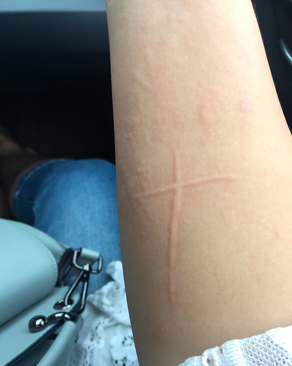 麻疹高发季怎么防控,荨麻疹换季导致全身发痒