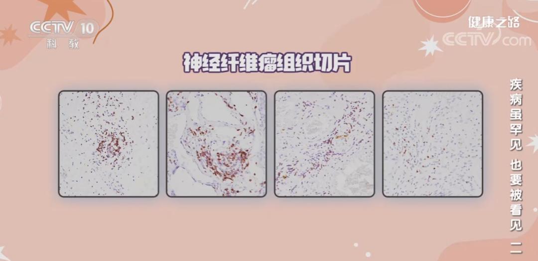 免疫疗法抗肿瘤视频,免疫疗法治疗肿瘤真的靠谱吗